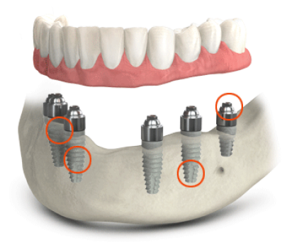 Dental Implants in a Nutshell