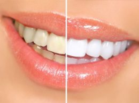 Teeth Whitening Collingwood