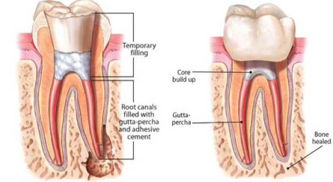 root canal treatment