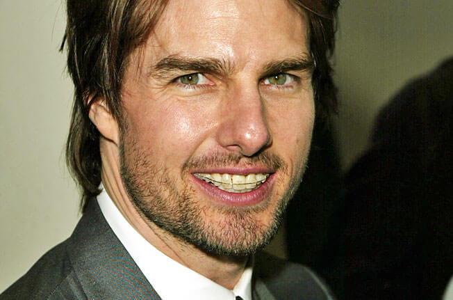 tom-cruise-braces