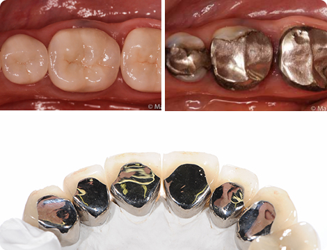 Amalgam Silver Mercury Filling Removal