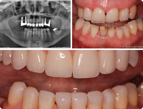 Case 2-Complex Reconstruction