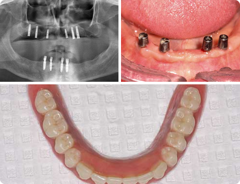 Case 5-Upper and Lower Full Arch Fixed