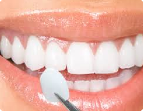 Teeth Whitening for Melbourne Patients