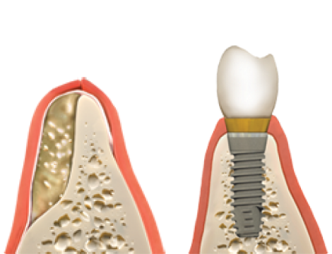 What Is The Cost Of The Bone Graft Procedure