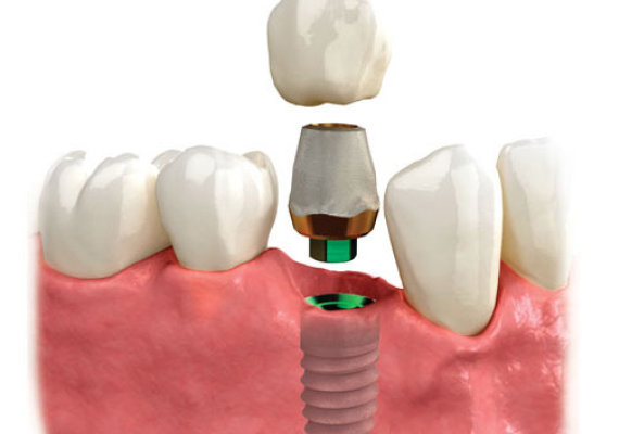 Your Options for Dental Implants Clinics