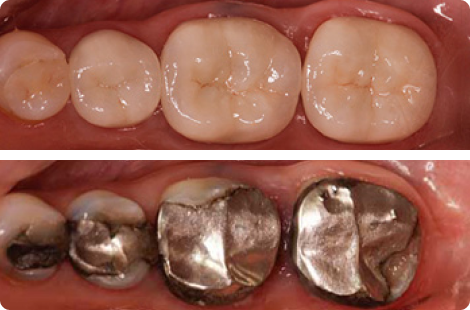 Difference between biomimetic & traditional dentistry